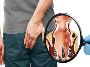 Haemorrhoids: 5 Ayurvedic Herbs To Treat Piles Naturally