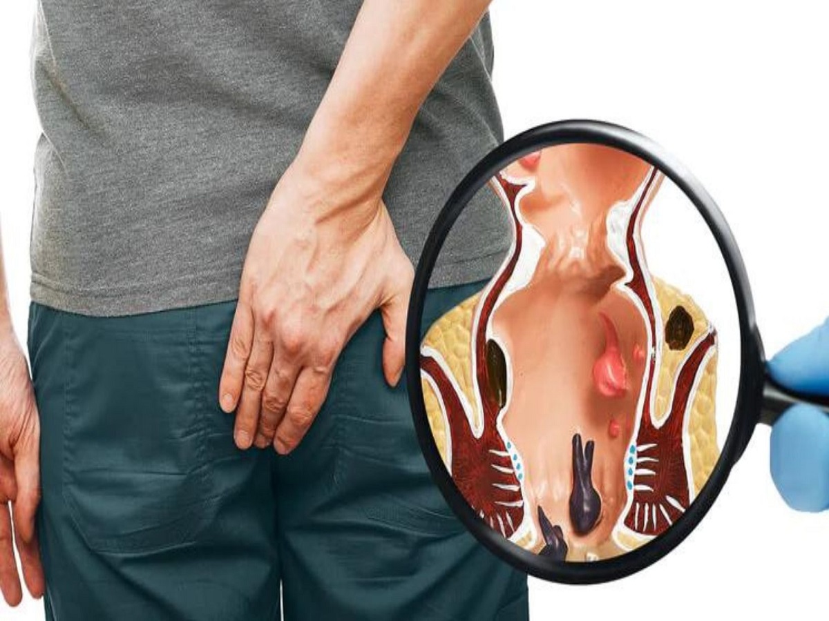 Haemorrhoids: 5 Ayurvedic Herbs To Treat Piles Naturally