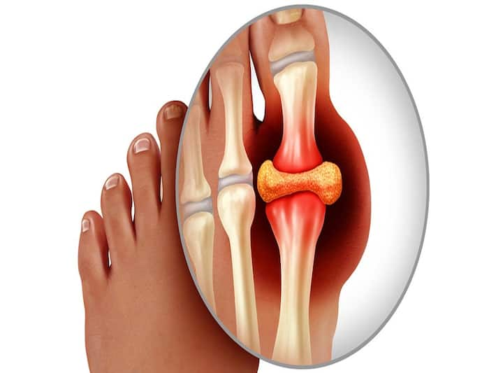 Gout Spikes: 5 Foods That Can Instantly Trigger Your Risk of Uric Acid ...