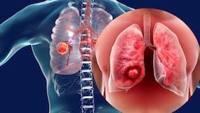 Are You At Risk of Lung Cancer If Your Family Has Suffered The Disease?