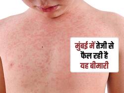 मुंबई में Measles से 4 बच्चों की मौत, इन वजहों से बढ़ती है ये बीमारी, जानें इससे बचाव के उपाय