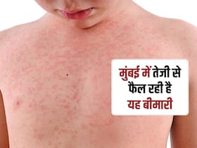 मुंबई में Measles से 4 बच्चों की मौत, इन वजहों से बढ़ती है ये बीमारी, जानें इससे बचाव के उपाय मुंबई में Measles से 4 बच्चों की मौत, इन वजहों से बढ़ती है ये बीमारी, जानें इससे बचाव के उपाय