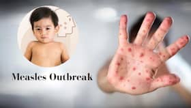 Mumbai: Measles Outbreak Leaves People Struggling With Watery Eyes, Acute Respiratory Problems Mumbai: Measles Outbreak Leaves People Struggling With Watery Eyes, Acute Respiratory Problems