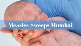 Measles Outbreak Sweeps Across Mumbai: How Big Is The Threat For Other Parts of The Country? Measles Outbreak Sweeps Across Mumbai: How Big Is The Threat For Other Parts of The Country?