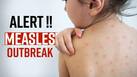 Measles Outbreak: 6 Cases Of Measles Found In India, Health Experts Warn, Watch Video