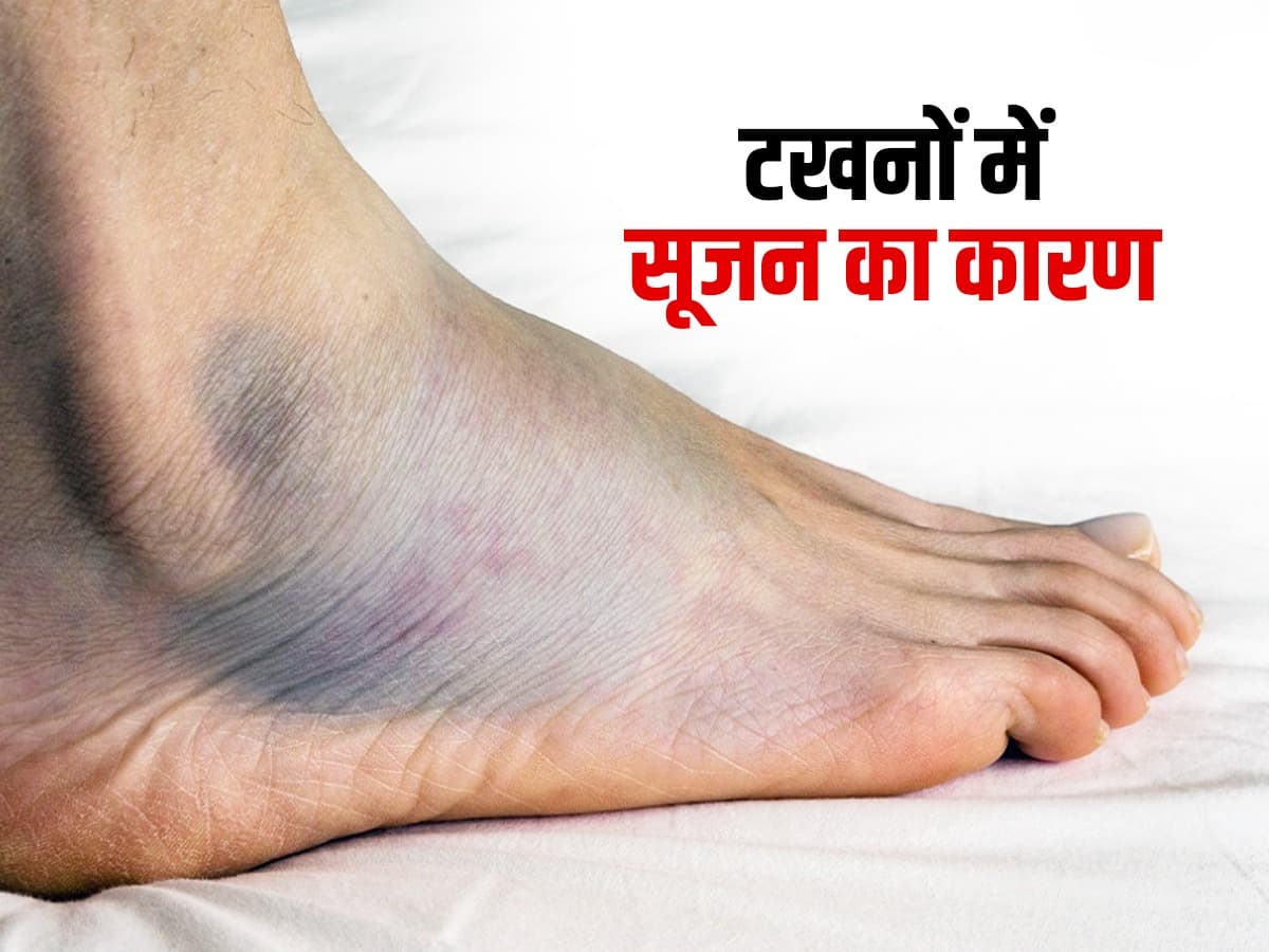टखनों में सूजन के 5 कारण Causes of Swelling in Ankle in Hindi