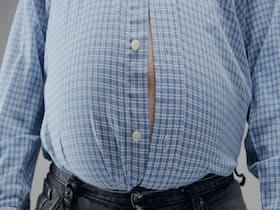 New Guidelines Recommends Weight-Loss Surgery For Those With BMI Over 30 New Guidelines Recommends Weight-Loss Surgery For Those With BMI Over 30