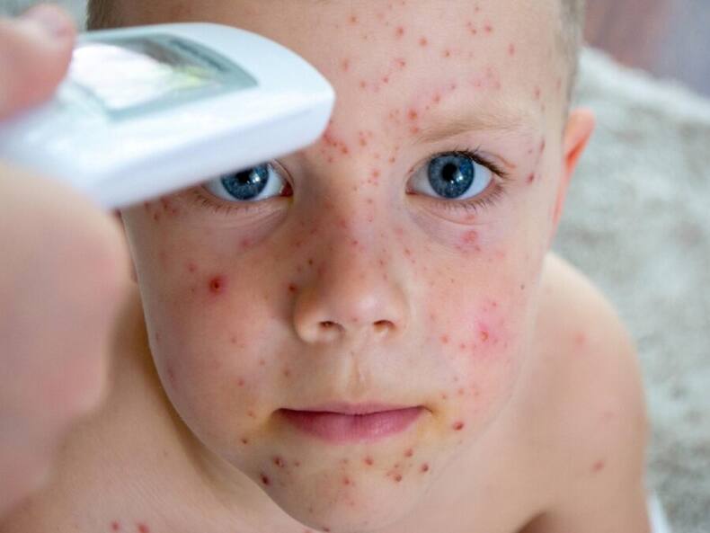 Can Vaccine Eliminate Measles And Rubella Infection?