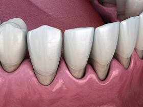 How Does Stress Affect Periodontal Disease?