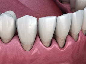 How Does Stress Affect Periodontal Disease?