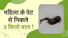 Hair In Stomach: बाल खाने से भरा पेट, ऑपरेशन के बाद निकले 3 किलो बाल, Watch Video