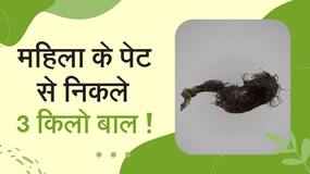 Hair In Stomach: बाल खाने से भरा पेट, ऑपरेशन के बाद निकले 3 किलो बाल, Watch Video