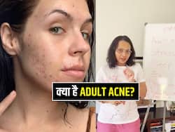 30 के बाद परेशान कर रहा है एक्ने और पिंपल्स? सेलिब्रिटी न्यूट्रिशनिस्ट से जानें क्या है इसका कारण