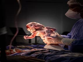 Can I Willingly Go For C-Section To Avoid Labour Pain? Expert Answers Can I Willingly Go For C-Section To Avoid Labour Pain? Expert Answers