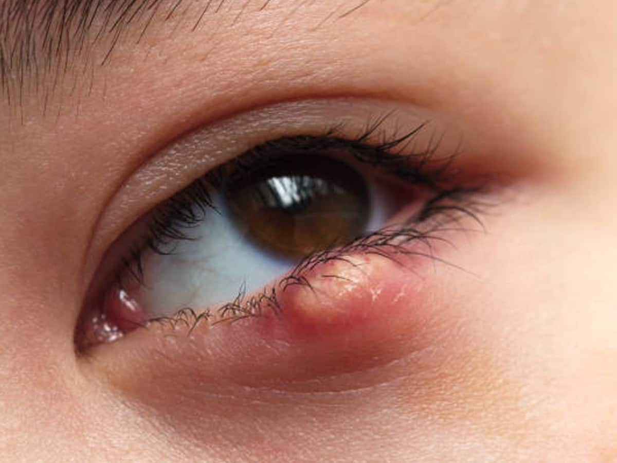 क्या आंख में होनेवाली गुहेरी संक्रामक होती है? जानें इसके कारण, लक्षण