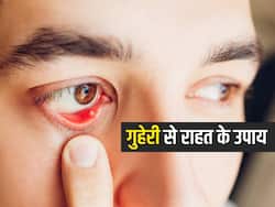 क्या आंख में होनेवाली गुहेरी संक्रामक होती है? जानें इसके कारण, लक्षण और घरेलू उपाय