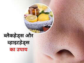 चेहरे के ब्लैकहेड्स और व्हाइटहेड्स को हटाने के लिए इस्तेमाल करें ये 5 नेचुरल उपाय