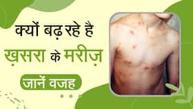 Measles virus: कोविड महामारी के बाद खसरा भारत में अपने पैर पसार रहा है, WHO ने दी चेतावनी, Watch Video Measles virus: कोविड महामारी के बाद खसरा भारत में अपने पैर पसार रहा है, WHO ने दी चेतावनी, Watch Video