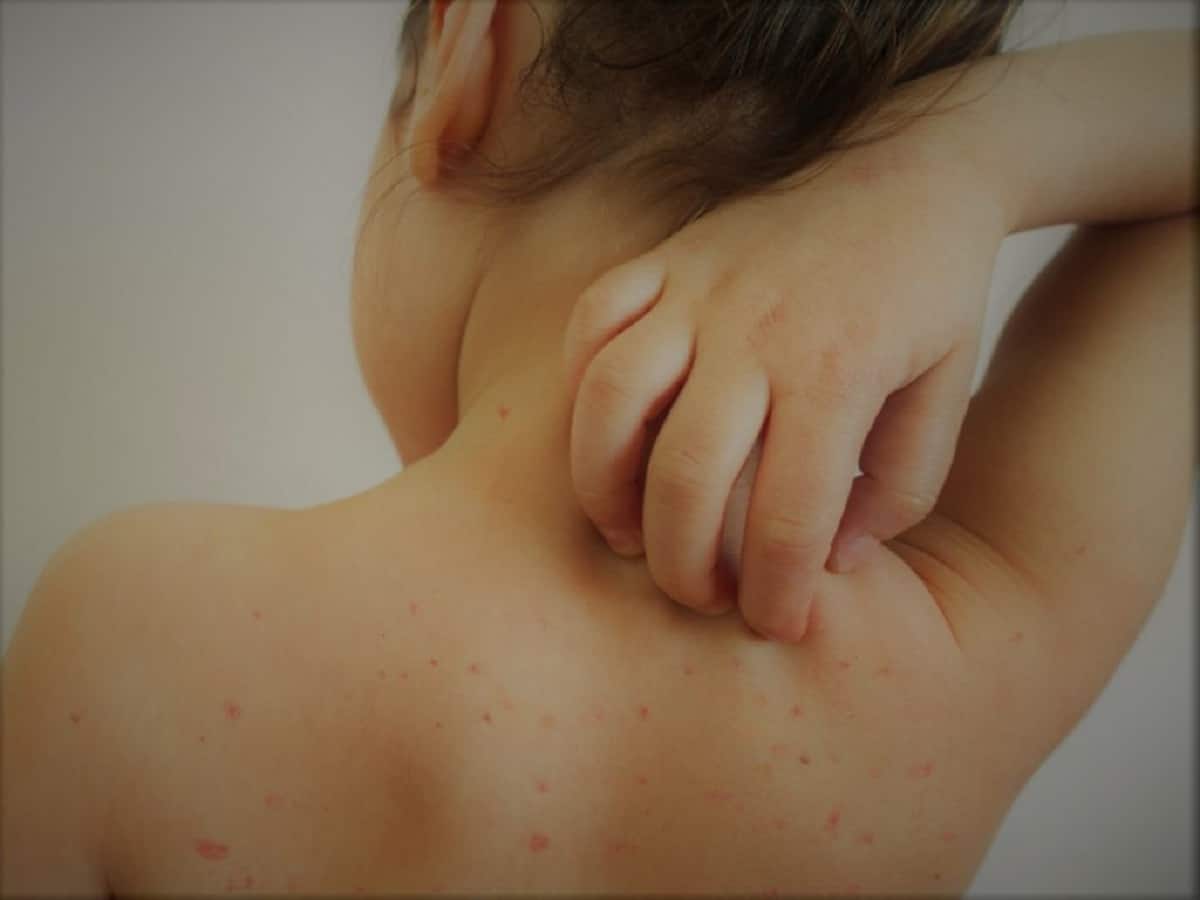 Measles Outbreak: Over 200 Cases, Death Tally Reaches 13