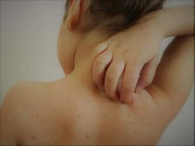 Measles Outbreak: Over 200 Cases, Death Tally Reaches 13