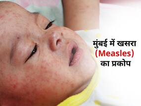 मुंबई में अचानक से बढ़े खसरा (Measles) के मामले, जांच के लिए स्वास्थ्य मंत्रालय ने भेजी टीम