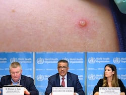 मंकीपॉक्स को WHO ने बताया ग्लोबल इमरजेंसी कहा खतरा अभी टला नहीं, एक्सपर्ट ने बताए बचाव के तरीके