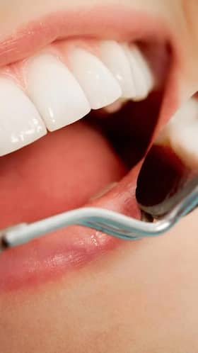 4 Ways Of Preventing Tooth Decay 4 Ways Of Preventing Tooth Decay