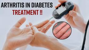 Arthritis & Diabetes: Treatment Of Arthritis In Diabetes, Watch Video
