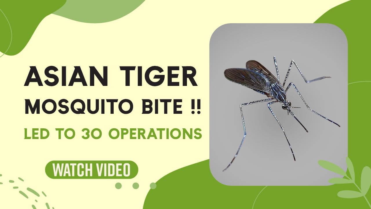 Asian Tiger Mosquito Bite: Man Undergoes 30 Operations, After Mosquito Bite, Watch Video | TheHealthSite.com