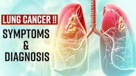 Lung Cancer: Early Signs & Causes Of Lung Cancer, Expert Speaks, Watch Video