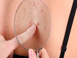 Don   t Cut Off Your Skin Tags, You Can Do This Instead