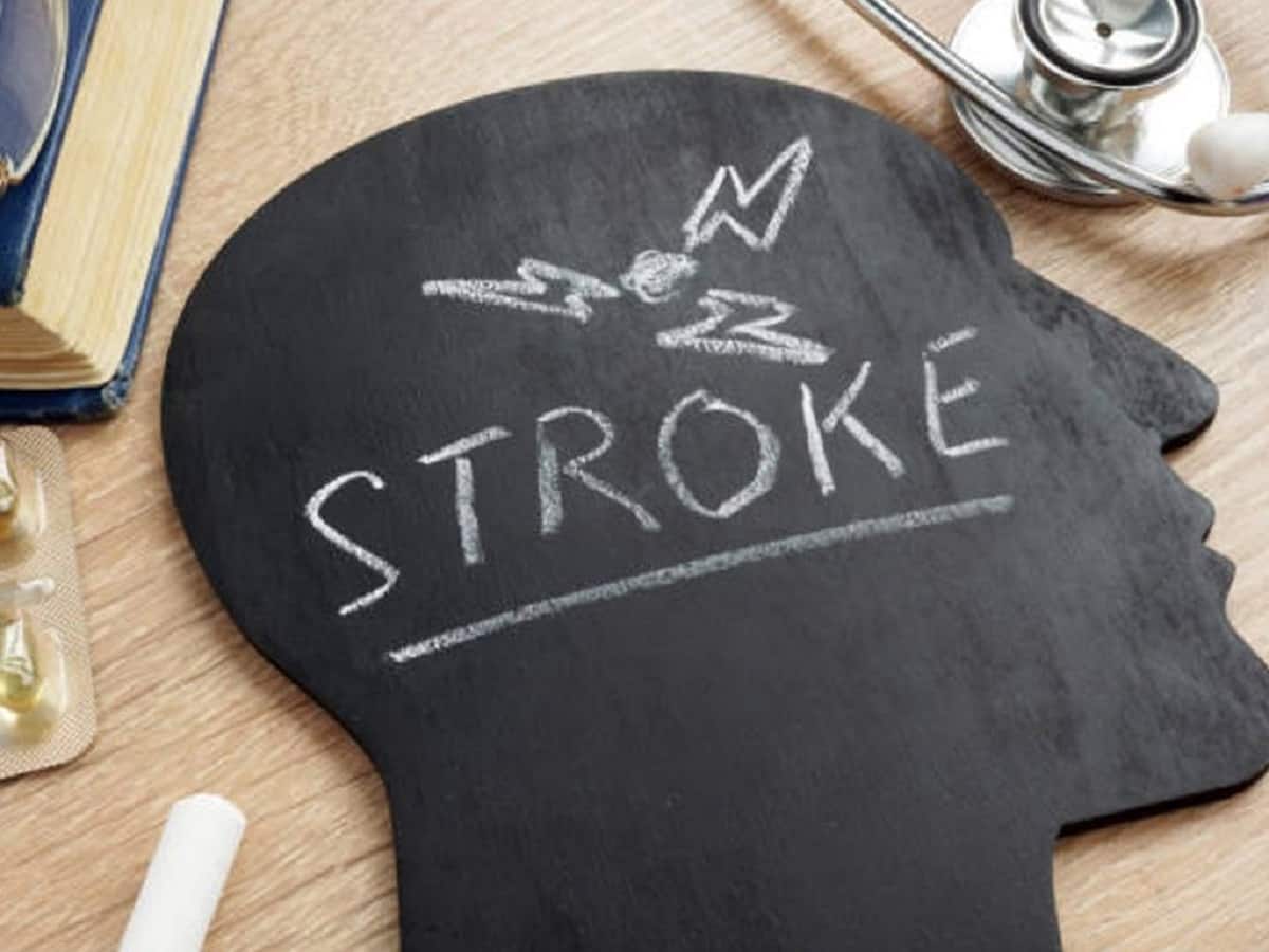 Myth Buster Common Misconceptions About Stroke