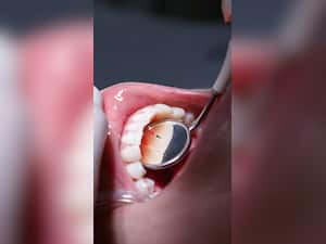 Beware! These 5 Diseases Can Occur Due To Dental Issues