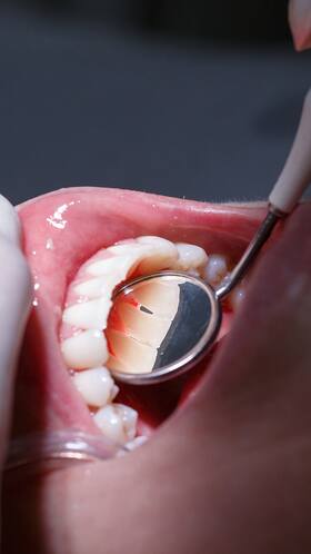 Beware! These 5 Diseases Can Occur Due To Dental Issues