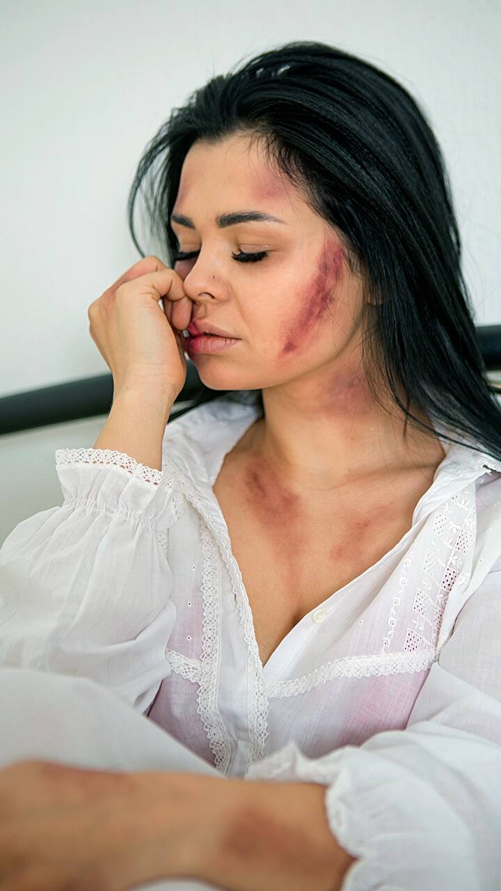 7 Reasons Why You Might Be Getting Bruises On Your Body