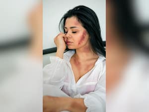 7 Reasons Why You Might Be Getting Bruises On Your Body