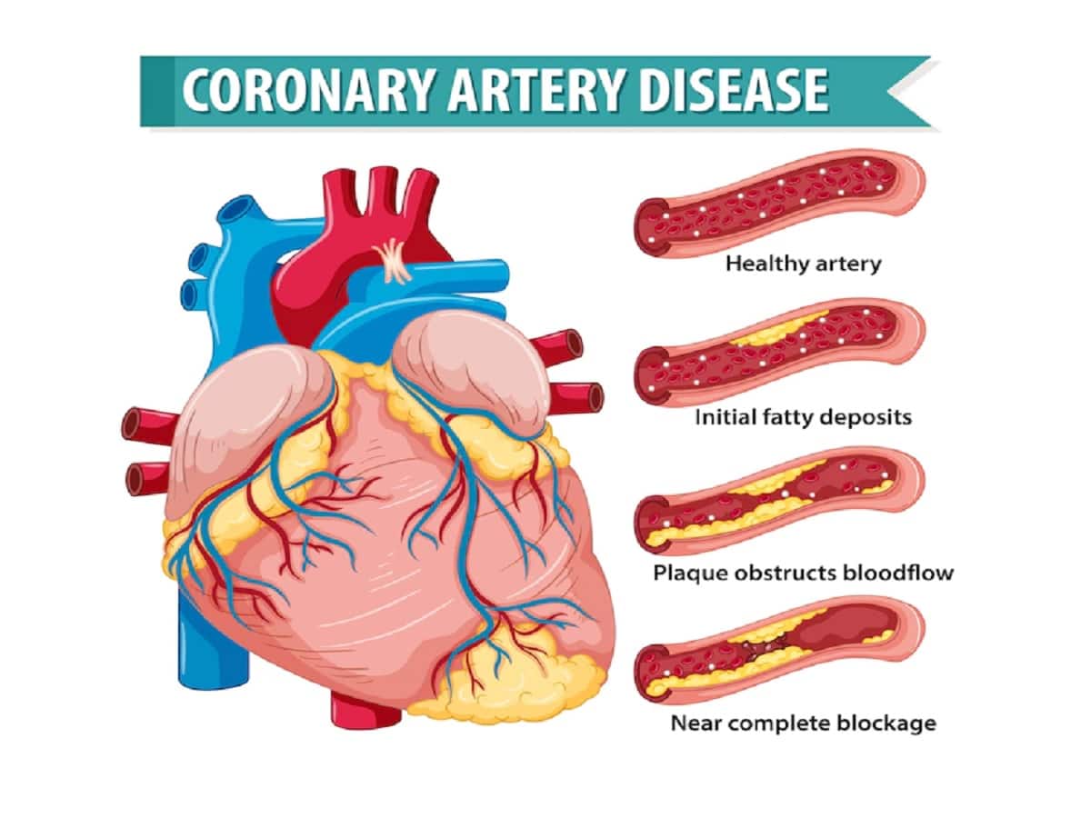 Coronary Artery Disease Whats New In The Treatment Of Heart Disease