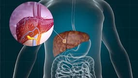 Fatty Liver Symptoms: 7 Unusual Signs You Have Liver Diseases Fatty Liver Symptoms: 7 Unusual Signs You Have Liver Diseases