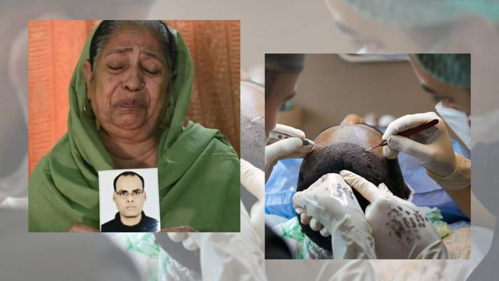 Kidney Failure and Then Total Organ Failure, How 30-Year-Old Man Died After Hair  Transplant Went Wrong 