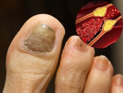 कोलेस्ट्रॉल बढ़ने पर सबसे पहले पैरों में दिखते हैं ये 4 बदलाव, जानिए पैरों में Cholesterol बढ़ने के संकेत