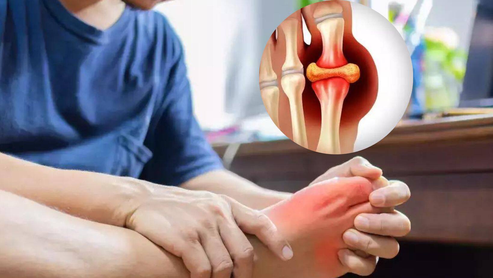 Uric Acid During Winter 10 Foods That Can Help Reduce Joint Pain 