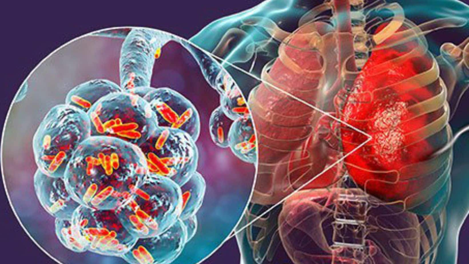 respiratory-syncytial-virus-infections-fresh-surge-reported-in-sweden