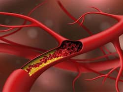 Bad Cholesterol: ये 3 ड्रिंक्स पीने से कम होने लगता है खराब कोलेस्ट्रॉल, खुल जाती हैं बंद नसें