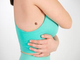 Treatment Of Birthmarks: When Surgery Is Recommended?