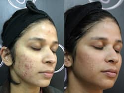 Types Of Acne Scars And How They Are Treated