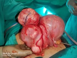 Multiple Fibroids Removed From The Uterus Of A 39-Year-Old Woman in Mumbai