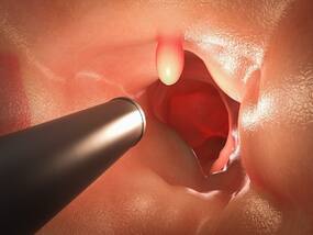 India Conducts First 5G Driven, Artificial Intelligence-Guided Colonoscopy Trial