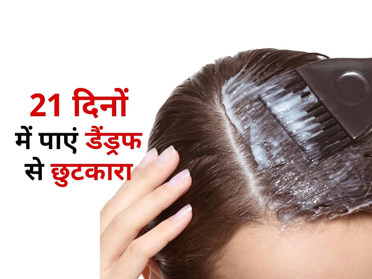 Hair Mask For Dandruff in Winter In Hindi सर्दियों में डैंड्रफ से 21