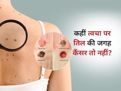 स्किन पर बना तिल कहीं Skin cancer तो नहीं? आज ही करें इन 5 संकेतों की पहचान