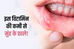 शरीर में इस विटामिन की कमी से होते हैं मुंह के 'छाले'! इन 5 घरेलू उपाय से मिनटों में पाएं छालों से छुटकारा